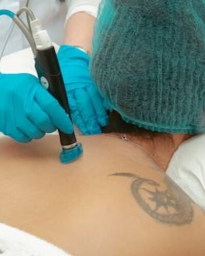 Top 8 Tattoo Removal Myths Experts Want You to Stop Believing